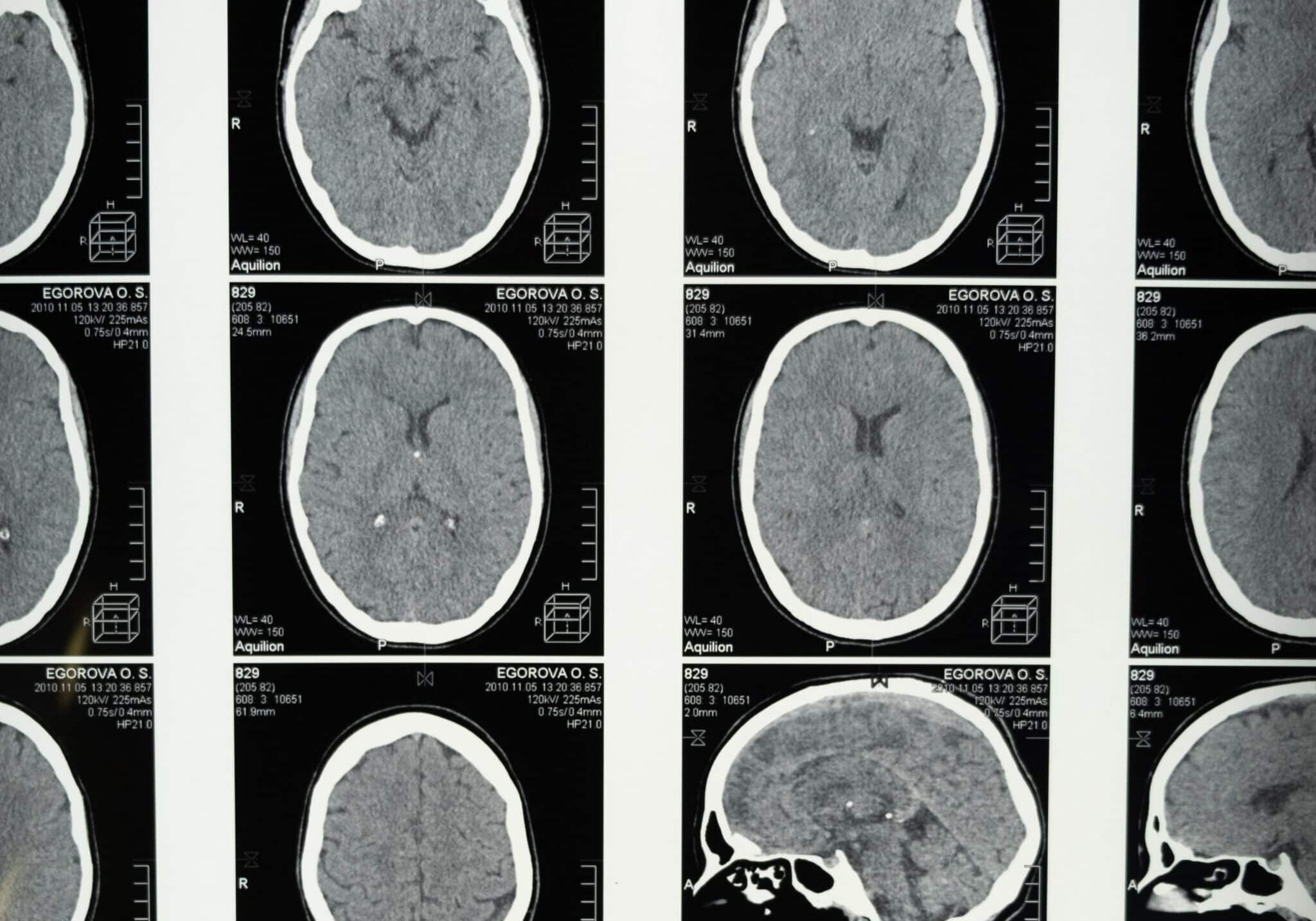 Traumatic Brain Injury resources and help - WA211